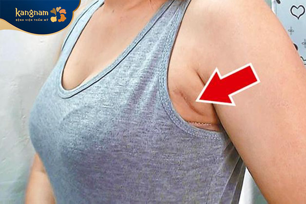 Ưu điểm vượt trội nhất của phương pháp nâng ngực qua đường nách là khả năng giấu sẹo tối đa