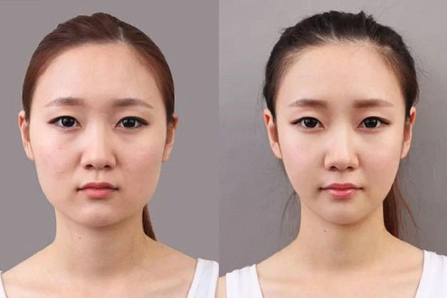 Người có gò má cao, nhô khiến gương mặt thiếu cân đối