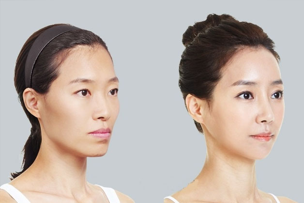 tiêm botox mang lại hiệu quả nhanh chóng