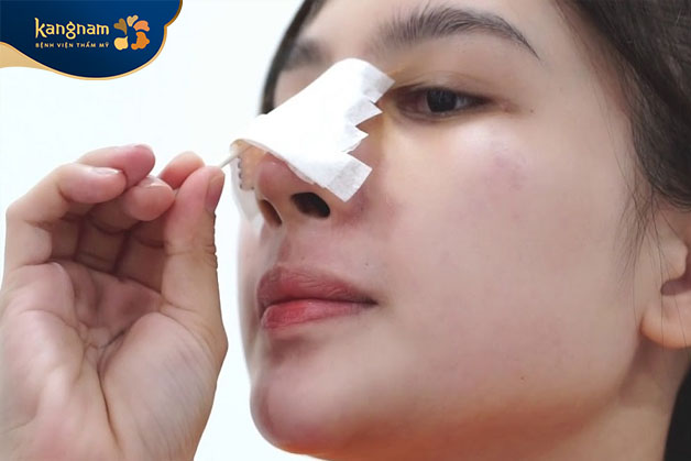 Vệ sinh mũi sạch sẽ sau khi cắt cánh mũi
