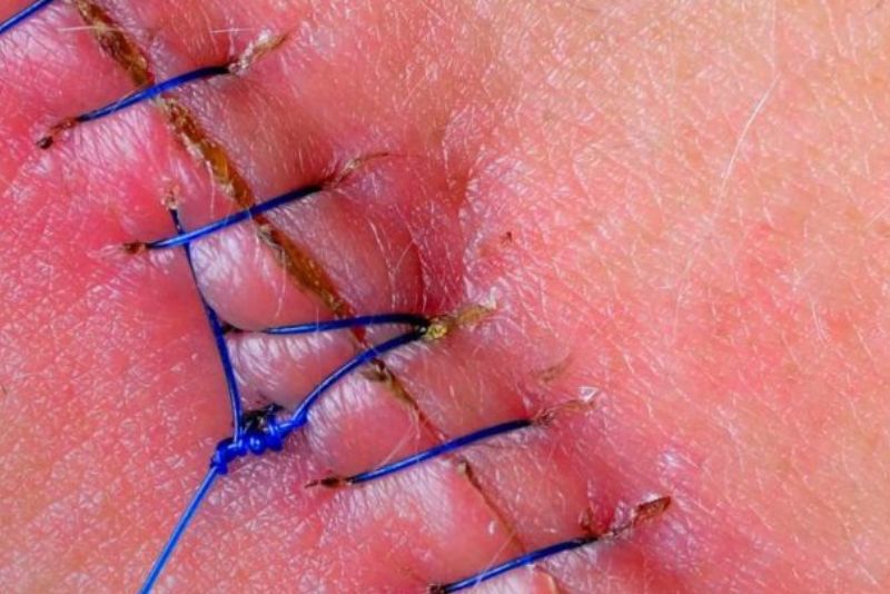 Vết khâu tầng sinh môn lành sau 2-3 tuần