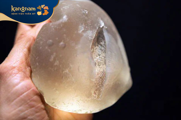 Vỡ túi độn ngực còn biết đến tên tiếng Anh là Breast Implant Rupture