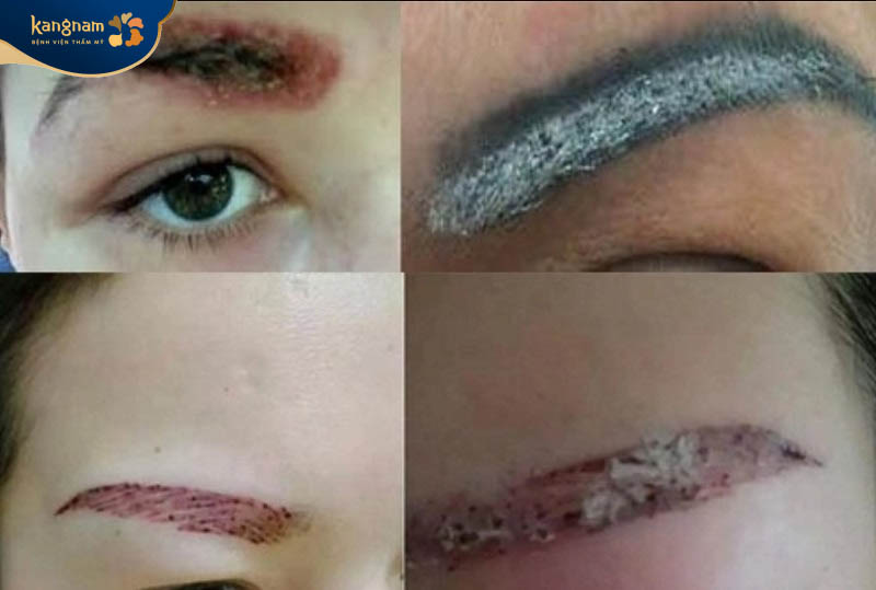 Không kiêng cữ đúng cách khiến lông mày dễ nhiễm trùng