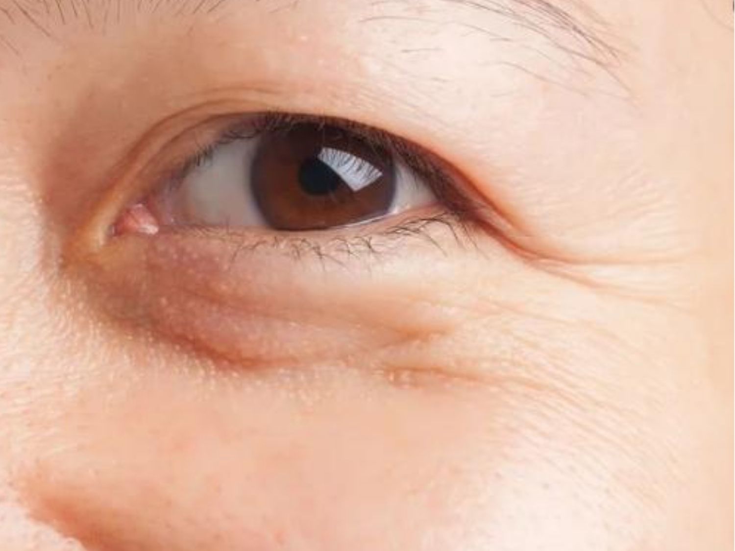 Rãnh lệ sâu và rõ rệt làm cho đôi mắt trông mệt mỏi