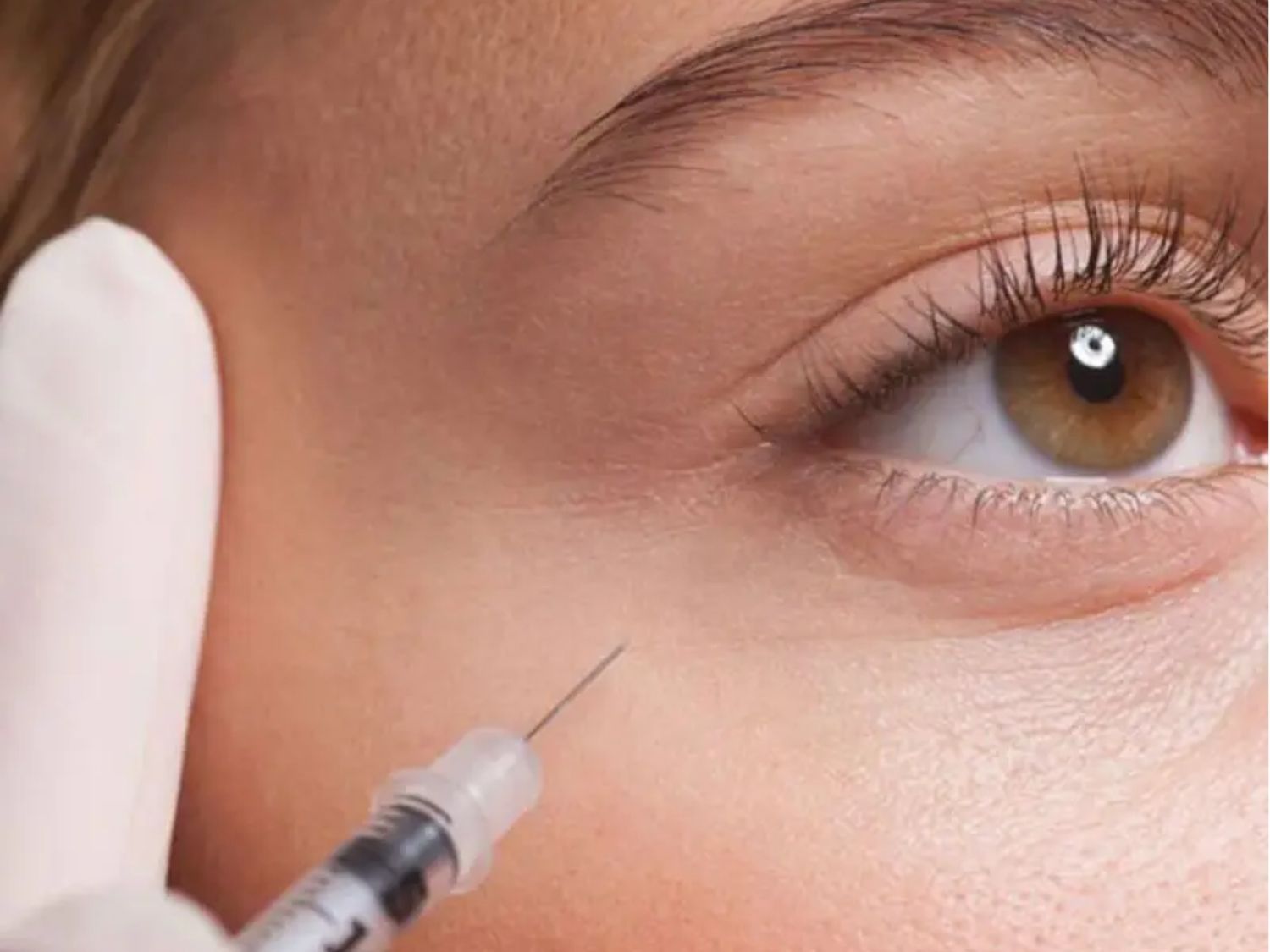 Tiêm filler lấp đầy rãnh lệ