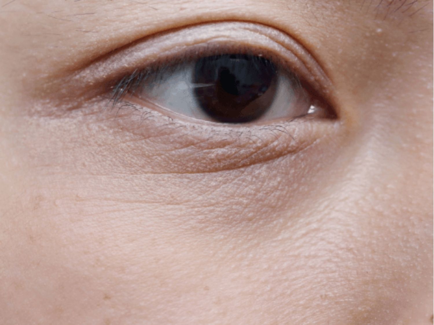 Rãnh lệ là đường lõm và nhăn nheo xuất hiện ở góc trong mắt