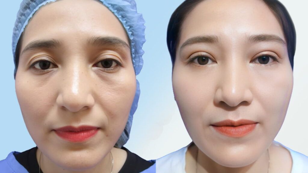 Xóa rãnh lệ là gì? Các phương pháp, chi phí & lưu ý quan trọng