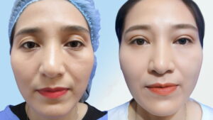 Xóa rãnh lệ là gì? Các phương pháp, chi phí & lưu ý quan trọng