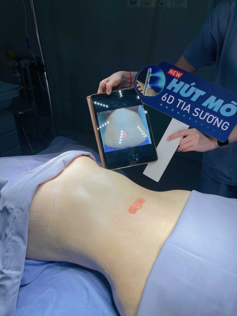 Lấy lại vòng eo “con kiến” cùng công nghệ tái tạo body mới nhất 2024