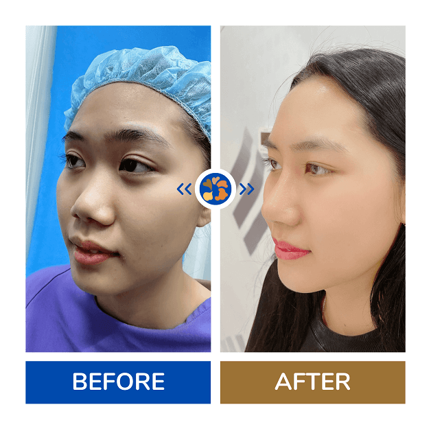 Khách hàng sau khi được bác sĩ nâng mũi, sở hữu dáng mũi cân đối, thon gọn