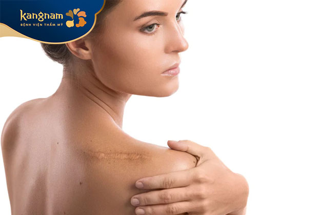 Sẹo ảnh hưởng đến tâm lý và cuộc sống của người mắc phải