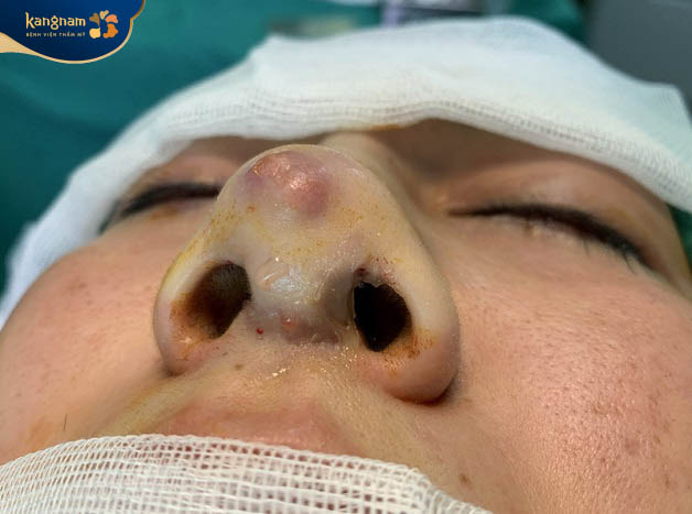 Mũi có tình trạng bất thường nên đến cơ sở y tế để kiểm tra