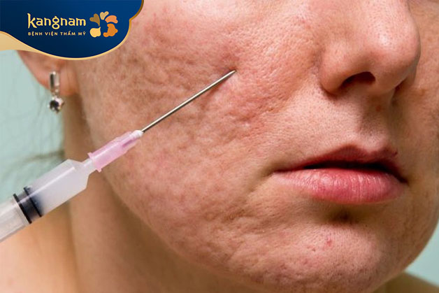 Bóc tách đáy sẹo