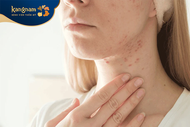 Da nhiều mụn mủ, mụn viêm không nên lăn kim