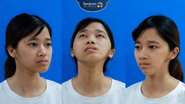 Gương mặt lõm hóp là khuyết điểm lớn nhất của Hường