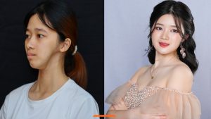 Trải qua 4 cuộc đại phẫu, cô gái mặt lõm lột xác xinh như công chúa