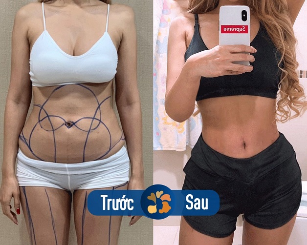 Khách hàng sở hữu vòng eo thon gọn sau khi được bác sĩ Felix Trần thực hiện hút mỡ