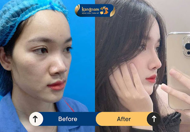 Thiết kế dáng mũi chuẩn tỷ lệ vàng, hài hòa với đường nét gương mặt khách hàng