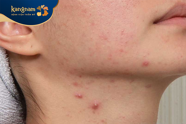 Không nặn mụn ở cổ khi mụn chưa chín