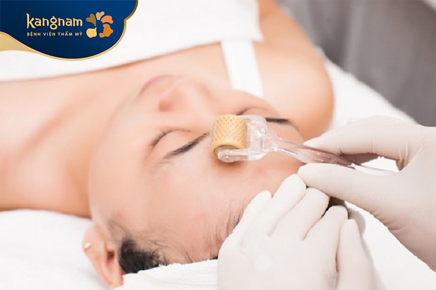 Chi phí lăn kim điều trị nám trên thị trường dao động từ 3.000.000 - 7.000.000