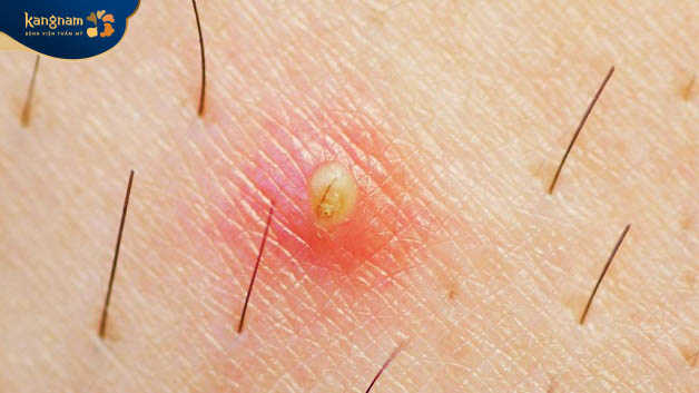 Lông mọc ngược là sợi lông mọc dưới da