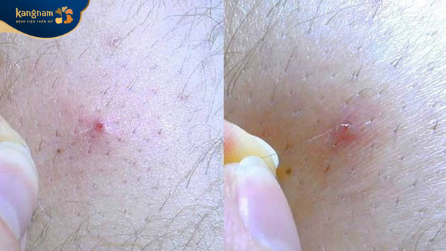 Lông mọc ngược có thể tự hết ở tình trạng nhẹ