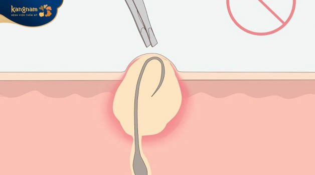 Hướng dẫn cách tự nhổ lông