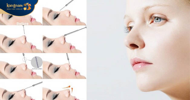 Nâng mũi chỉ Hiko sử dụng chỉ PDO