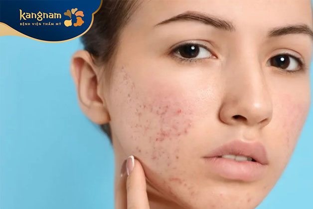 Vùng da bị mụn viêm nhiễm nặng