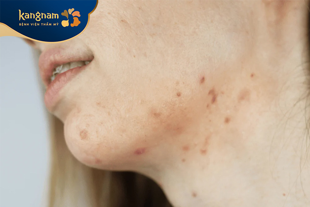 Hầu hết mụn mọc ở cổ thường có dạng mụn đỏ, mụn ẩn hoặc mụn mủ viêm