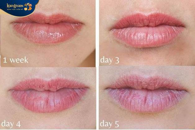 Sau phun môi vùng da hơi căng, ê và sưng nề nhẹ