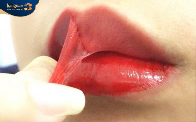 Tuyệt đối không tự bóc lớp vảy ở môi