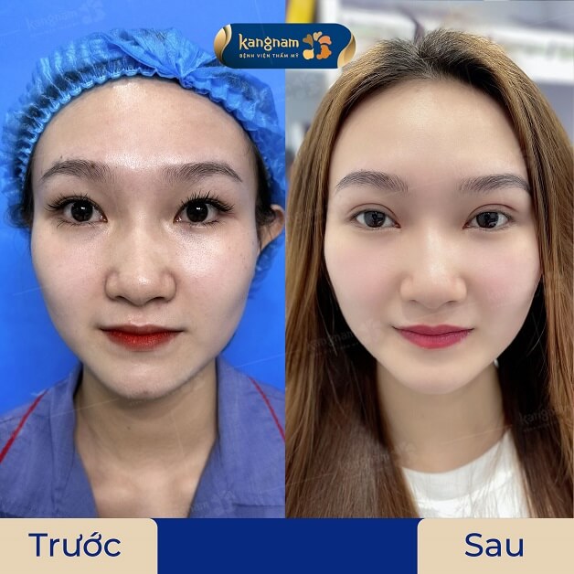 Khách hàng sau khi được bác sĩ Henry cắt mí