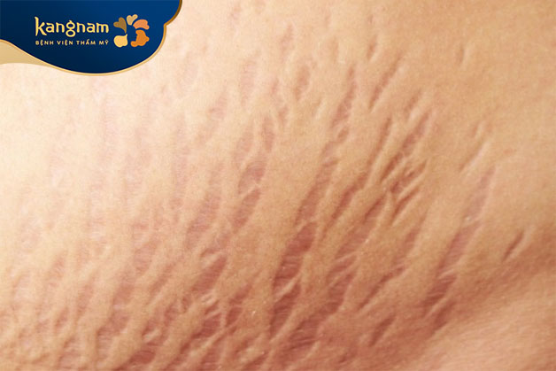 Sẹo giãn là dạng sẹo do mô da bị kéo căng và mở rộng