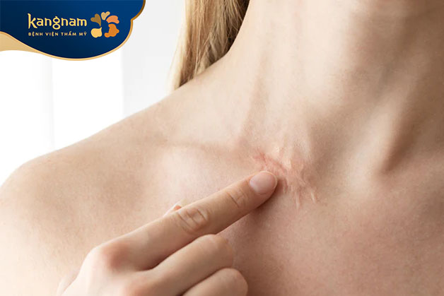 Sẹo hình thành thông qua quá trình làm lành tự nhiên của cơ thể