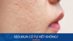 Sẹo mụn có tự hết? Giải đáp và cách điều trị hiệu quả