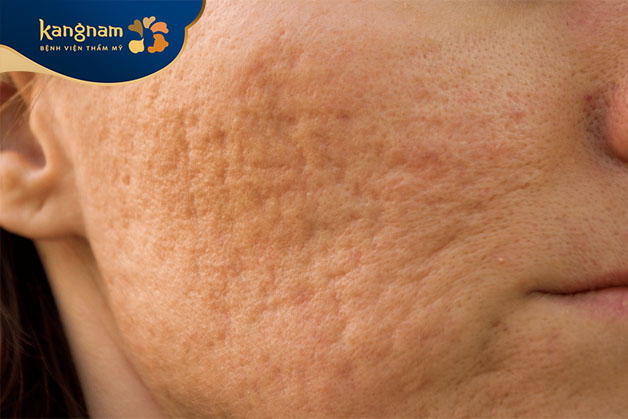 Sẹo mụn không tự hết