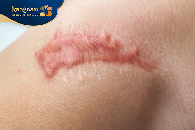 Sẹo phì đại là vết sẹo trồi lên trên hẳn so với bề mặt da