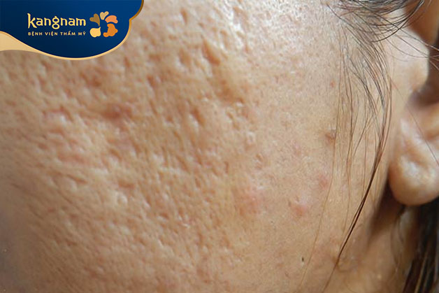 Sẹo rỗ do mụn trứng cá để lại