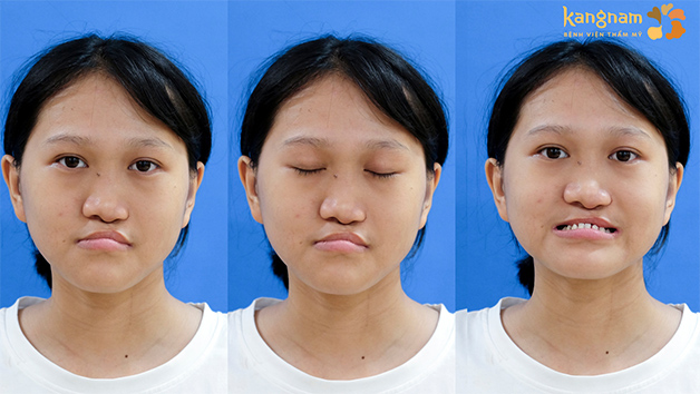 Ngoại hình của Xuân Mai khi trải qua 8 cuộc phẫu thuật nhưng chưa cải thiện