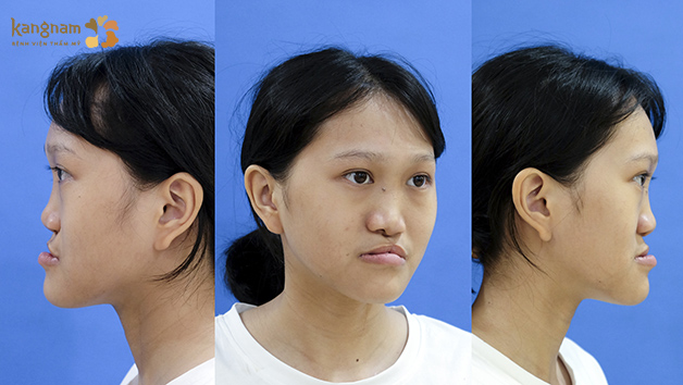 Xuân mai gặp di chứng khe hở môi vòm, khớp cắn ngược, mũi dị dạng, môi dị tật