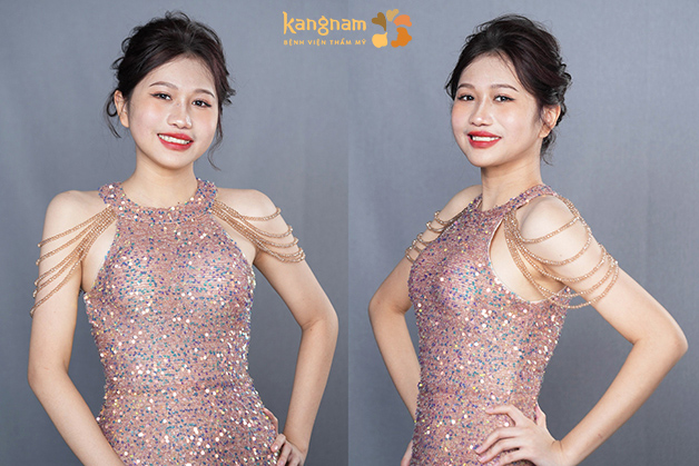 Xuân Mai tỏa sáng với diện mạo xinh đẹp hơn, mũi cao, môi và phần hàm hoàn chỉnh, cân đối