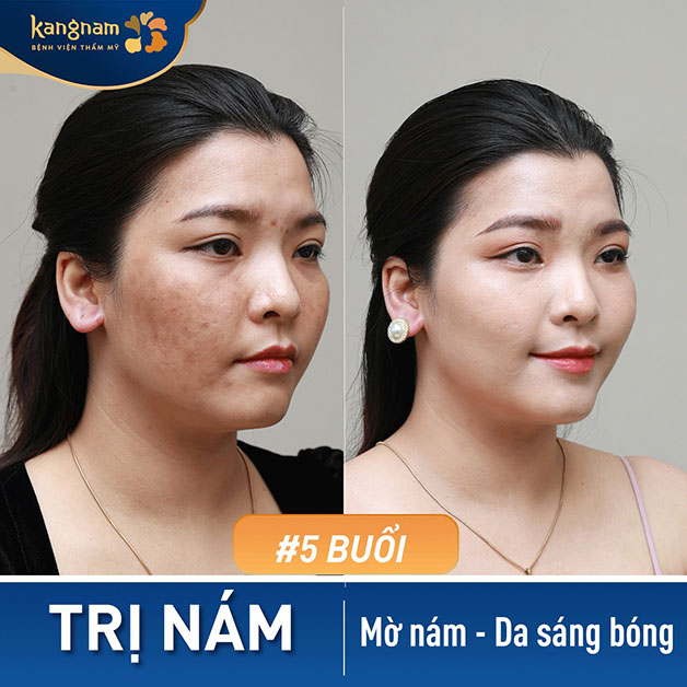 Hết nám, da sáng bóng và khỏe khoắn