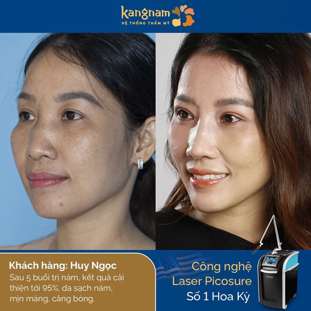 Xóa nám hiệu quả cho khách hàng bị nám lâu năm