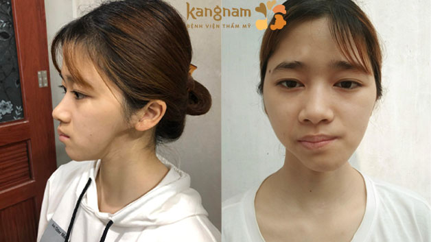 Ninh Thị Thu Hường có khuôn mặt lõm do di chứng sau phẫu thuật cắt u