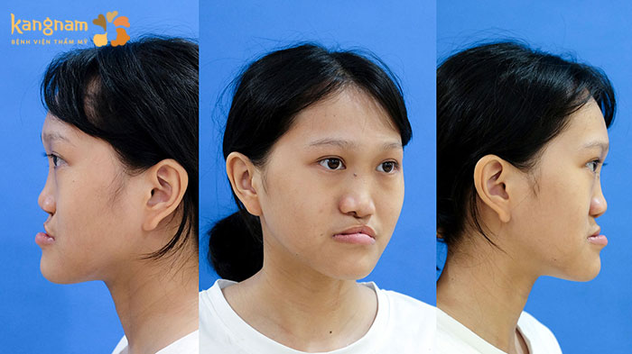 Xuân Mai mang nhiều dị tật bao gồm sứt môi, hở hàm ếch, lỗ thông mũi miệng