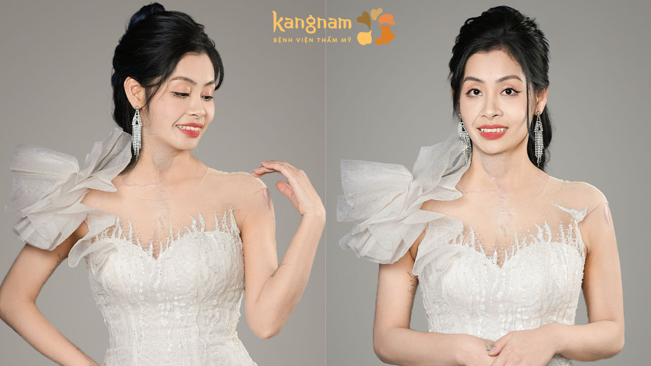 Phạm Diệu Linh “lột xác” đầy tự tin sau khi loại bỏ được vết sẹo lớn