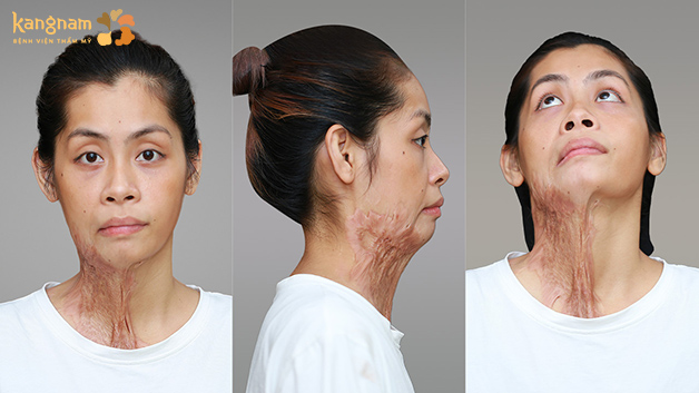 Tình trạng sẹo co kéo nặng của Diệu Linh sau khi bị chồng tạt axit