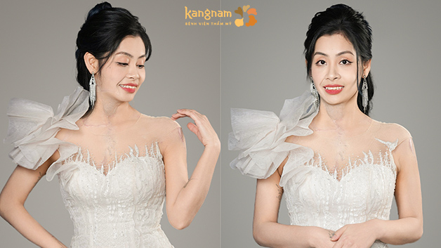 Diệu Linh xóa bỏ vết sẹo quá khứ, trở nên xinh đẹp và mạnh mẽ hơn