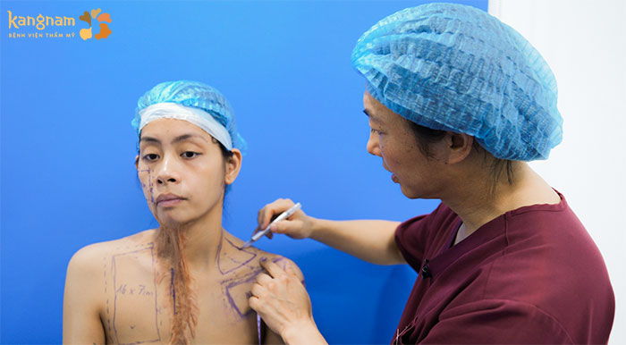 Bác sĩ đánh dấu vị trí đặt túi giãn da